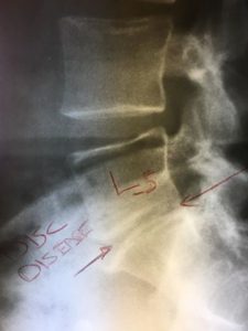 X-ray with chiropractic markings