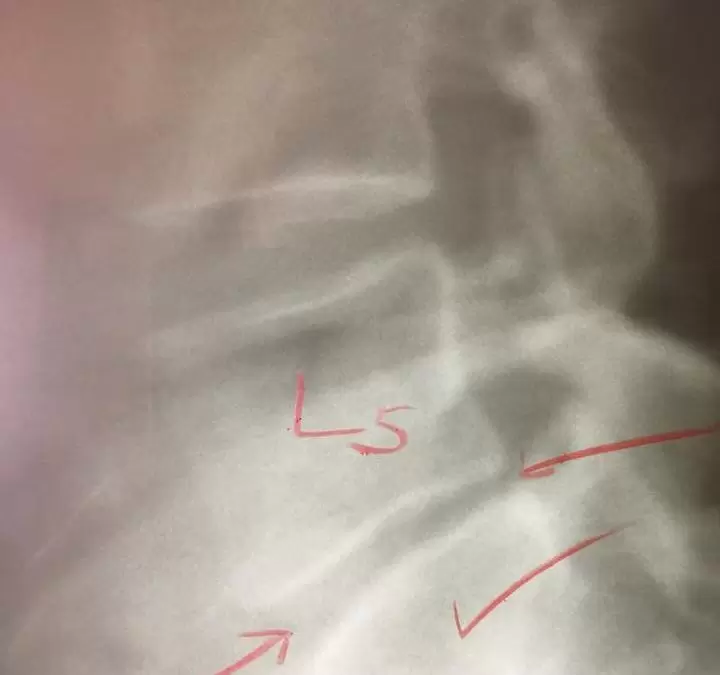 close-up x-ray of spine with chiropractic markings